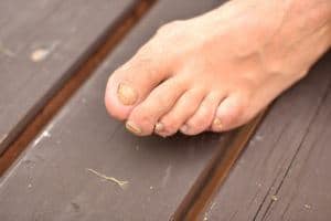 yellow-toenails